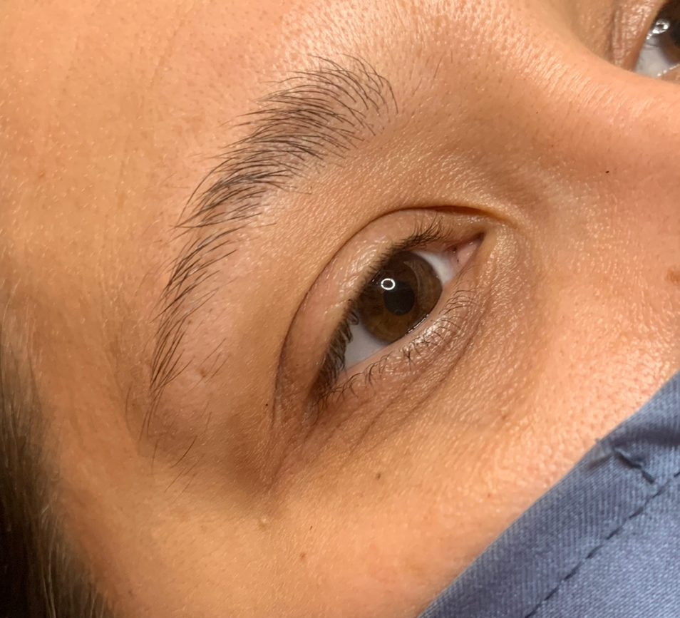 BROW LIFTING, AUGENBRAUENLIFTING, AUGENBRAUENLAMINIERUNG